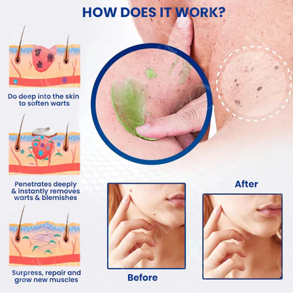 ✅ Official Store: Oveallgo™ Ultra NatureErase Instant Mole & Spot Removal Gel